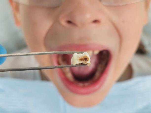 Best Emergency Tooth Extraction in Harvest, AL